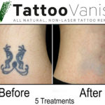 Tattoo Removal Results