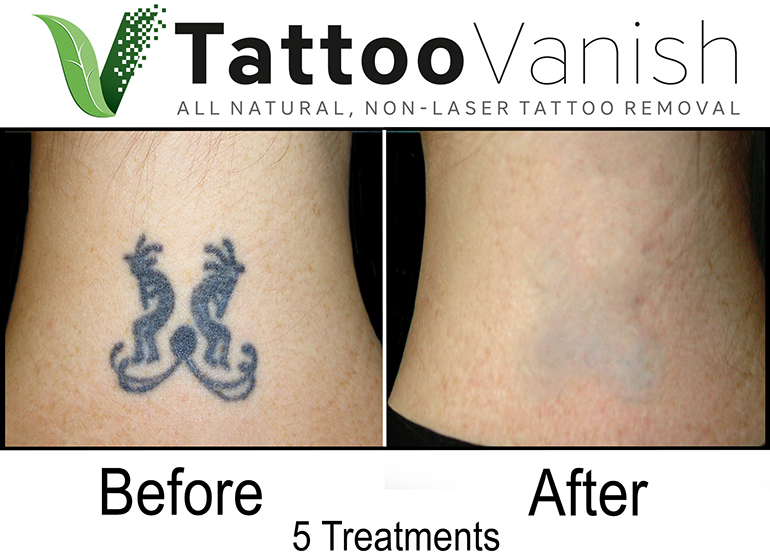 Methods of tattoo removal