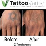 After Tattoo Vanish