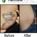 All Natural Tattoo Removal Before and After