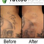 Best Tattoo Removal Method