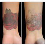 Before and After All Natural Tattoo Removal