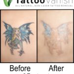 Before and After Tattoo Vanish Method