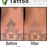 Tattoo Vanish Tattoo Removal Results