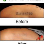 Best All Natural Tattoo Removal Results