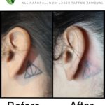 Tattoo Removal Results After 1 Treatment