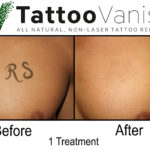 Before and After Tattoo Removal