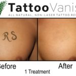 Before and After Natural Tattoo Removal