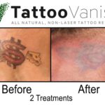 Best Tattoo Removal Results