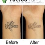 Before and After Tattoo Vanish