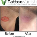 Tattoo Vanish Before and After