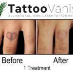 Non-Laser Tattoo Removal Before and After