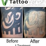 Natural Tattoo Removal Before and After