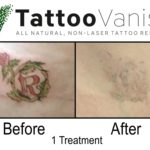 Tattoo Removal Before and After