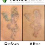 Laser Tattoo Removal vs Tattoo Vanish Results