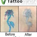 After 1 Tattoo Removal Treatment