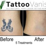 Laser Tattoo Removal Results vs. Tattoo Vanish Results