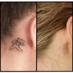 Before and After Natural, Non-Laser Tattoo Removal