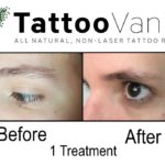 Before and After Permanent Makeup Removal