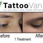 Eyebrow Tattoo Removal Before and After