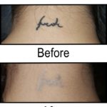 The Results of the Best Non-Laser Tattoo Removal Method