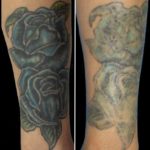 Natural Tattoo Removal Before After