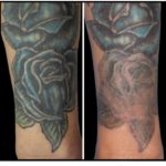 Non-Laser Tattoo Removal Before After