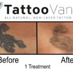 Tattoo Removal Before After