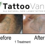 Best All Natural Tattoo Removal Method