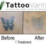 Best Tattoo Removal Results