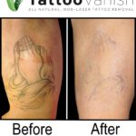 Best Non-Laser Tattoo Removal Results