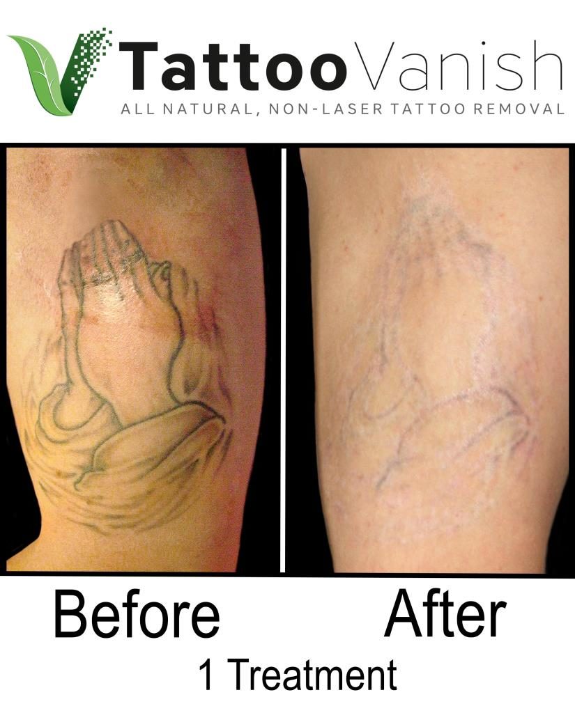 Before and After Gallery  DFW Tattoo Removal
