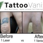 Best Non-Laser Tattoo Removal Method