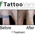 Tattoo Removal With The Tattoo Vanish Method