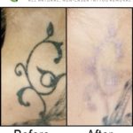 Laser Tattoo Removal vs Tattoo Vanish Method