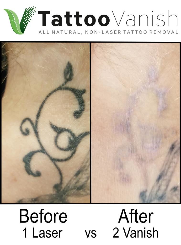 Before and After Tattoo Removal  Get the Best Results the AllNatural Way   Tattoo Removal Pictures  Photos  Tattoo Vanish