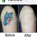 Before and After Tattoo Removal With Tattoo Vanish