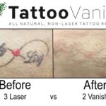 Tattoo Vanish Method Results vs Laser Tattoo Removal