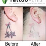 Tattoo Removal Results With Tattoo Vanish