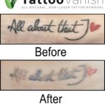 After Non-Laser Tattoo Removal