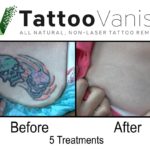 After All Natural Tattoo Removal