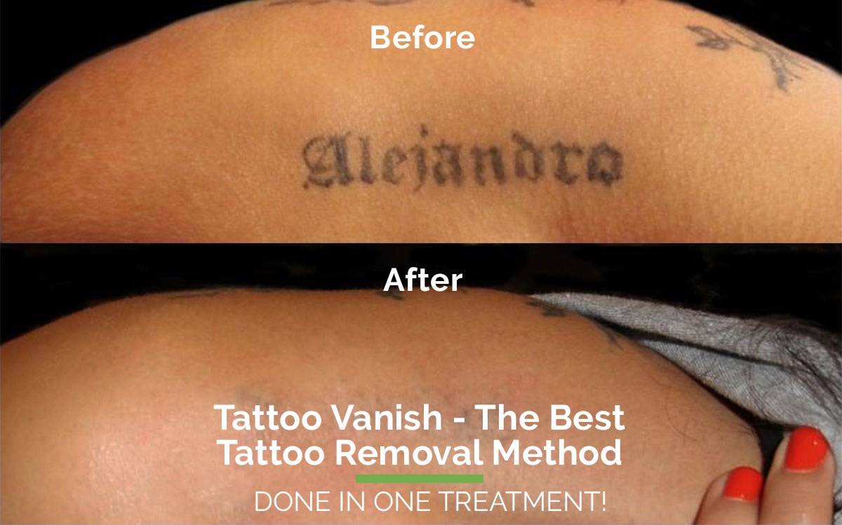 One evidence of successfully treating oxidation  rTattooRemoval