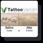 Natural Tattoo Removal