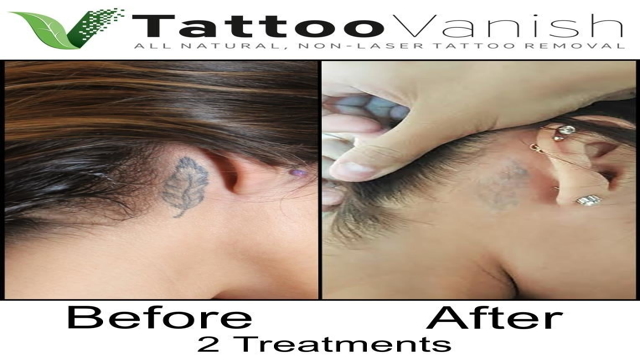 best tattoo removal cream