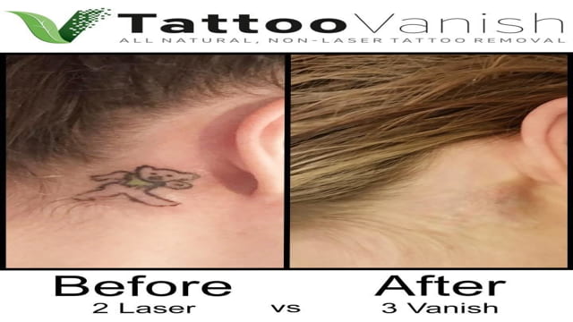 fast tattoo removal