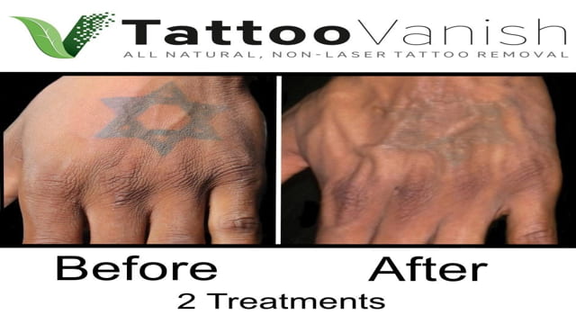 tattoo removal without laser