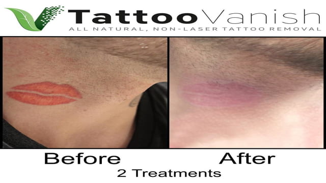 tattoo removal certification